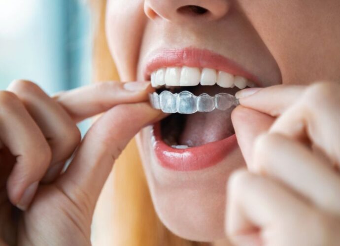 Kobieta zakłada nakładkę ortodontyczną na zęby