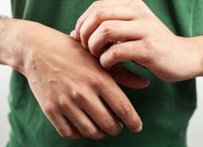 Świąd - jeden z objawów alergii na nikiel