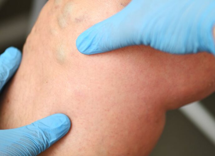 Lekarz bada żylaki na nogach