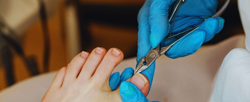 Korekcja wrastających paznokci