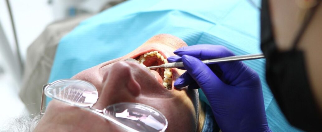 Wybielanie zębów to jeden z najczęściej wykonywanych zabiegów z zakresu stomatologii estetycznej